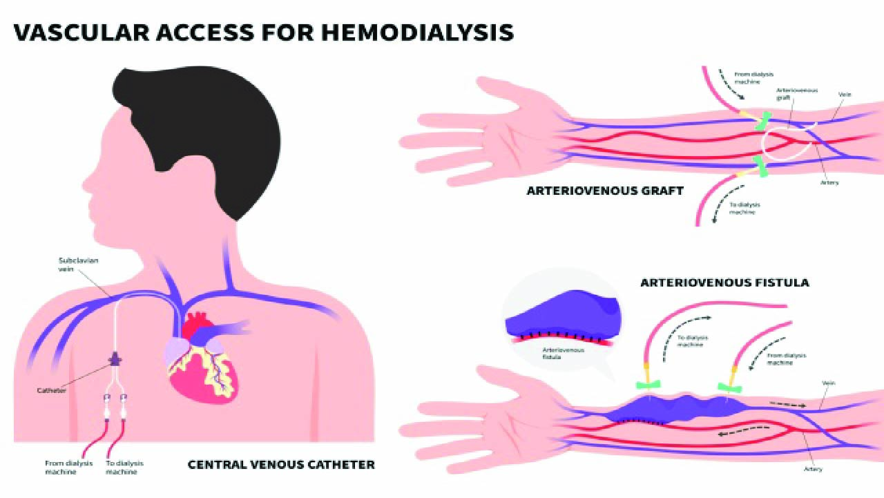 Vascular Access in CKRT